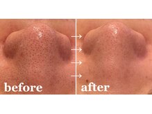 リム(Lim:)/ハイドロ毛穴洗浄◆小顔エステ