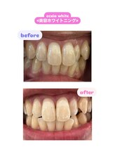 エクシアホワイトニング 倉敷店/美容ホワイトニングの効果！