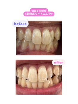 エクシアホワイトニング 倉敷店/美容ホワイトニングの効果!