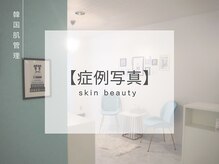 ベル 広島(Belle)/ハーブピーリング｜ニキビケア