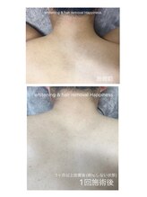 ハピネス 広島並木通り店(Happiness)/背中脱毛Before→After