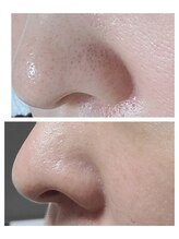 エスボーテ(sbeaute)/プラズマ+ダクトピール