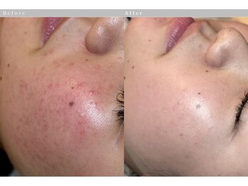 ルーツリー(Rootree)/肌管理フェイシャル