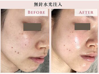 レクラ バイ ドクターエイチ(L'ECLAT by Doctor.H)/無針水光注入”美容液真皮導入”