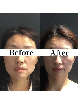 リフェイス(Re:face)/エラ解消、たるみがリフトアップ