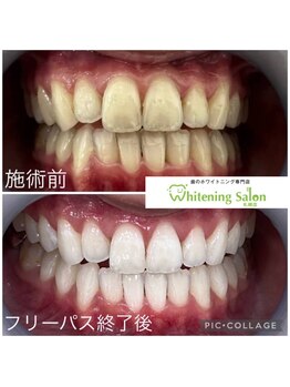 ホワイトニングサロン 札幌店/【ホワイトニング】#札幌#大通り