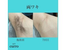 アクト クロ(ACT curro)/【両ワキ】脱毛施術例