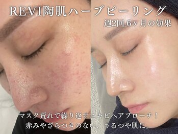 エムラボ 表参道店(M LABO)/国産ハーブピーリング