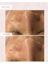 プレジール(Plaisir)/サーマトリックス+ララピールLDM