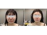 エステで出来る小顔RFリフトアップ☆即小顔へ☆
