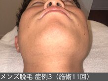 オアシスラグーン(OASIS LAGOON)/メンズ脱毛（症例3 施術11回）