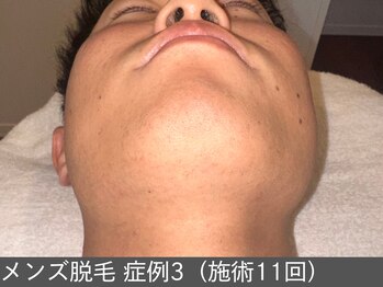 オアシスラグーン(OASIS LAGOON)/メンズ脱毛(症例3 施術11回)