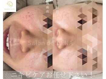 サロンドレナ 名駅店/ハーブピーリング サロンドレナ