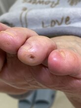 フットメンテ 巻き爪矯正センター 南浦和/魚の目のケア