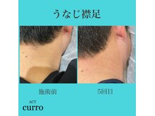 アクト クロ(ACT curro)/【うなじ襟足】脱毛施術例
