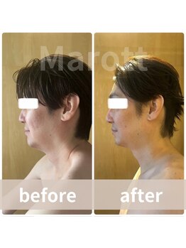 マロット 表参道店(Marott)/【40代男性】瞬間小顔リフト