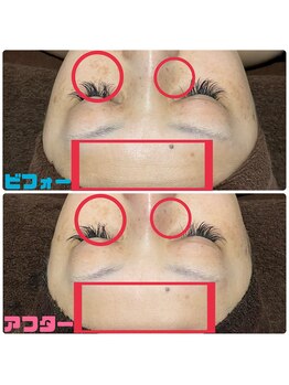 ソウ(SOU)/ハーブピーリング 1回の効果