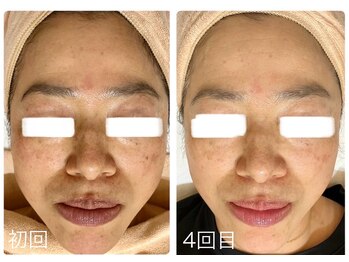 ポモナ 横浜馬車道店(Pomona)/シミ、くすみがなくなり若見え◎