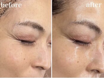 ホワイトアクア 浜松店(WHITE AQUA)/ララピール/ニキビケア