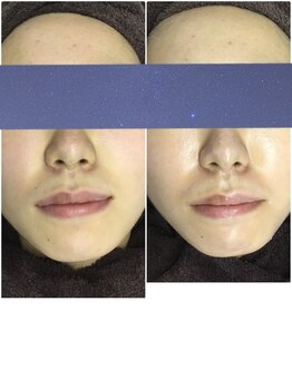 ビー 銀座一丁目駅店(Bee)/乳酸菌ピーリング