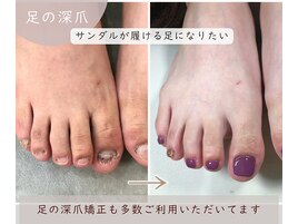 足の深爪矯正も人気です！