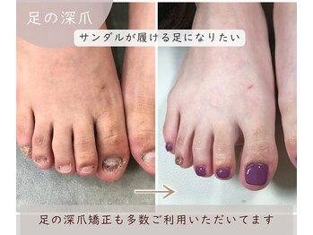足の深爪矯正も人気です！