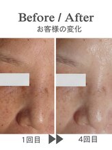 ココプレジール(Cocoplaisir)/シミ/くすみ