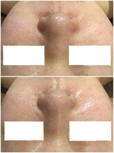 アンジュ(Ange)/陶肌トリートメント