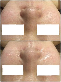 アンジュ(Ange)/陶肌トリートメント