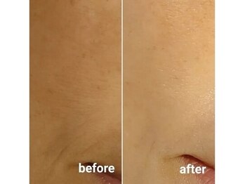 ビューティーアンドビースト(Beauty&Beast)/◆小じわ悩み◆beforeａｆｔｅｒ