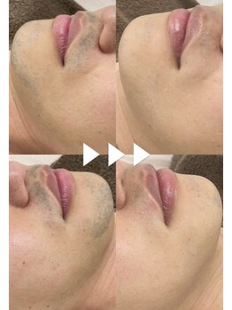 カルディエ(Cardie)/ひげ脱毛　ビフォーアフター