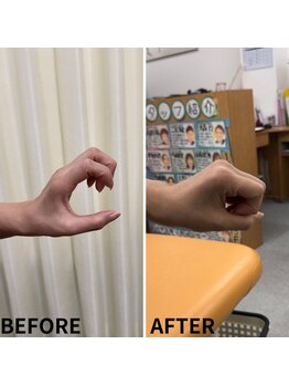 シナプスケアセンター 十三院(SYNAPSE CARE CENTER)/【シナプス療法】で手の動き改善