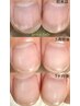 【男性】自爪矯正コース　12,000
