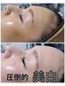 【顔WAX＆プラズマフェイシャル】圧倒的美白、透明感16000円