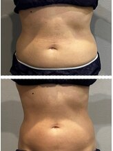 ラヴィエール(Laviere)/レディース痩身120分4回目