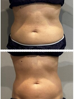 ラヴィエール(Laviere)/レディース痩身120分4回目