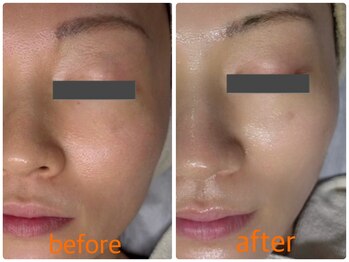 シロ(CHILO)/ハーブピーリング　2週間後