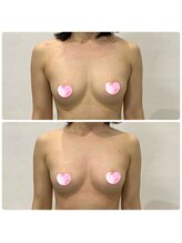 ラシサ(La-sisa)/筋膜バストケアの変化