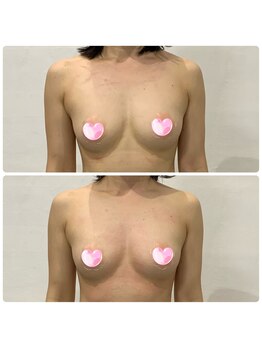ラシサ(La-sisa)/筋膜バストケアの変化