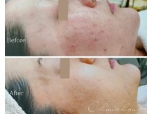 シュシュ(Chou chou)/【Before★After】ニキビ改善