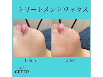 アクト クロ(ACT curro)/【フェイシャル】施術例