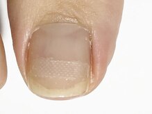 ティアラリュクス 東林間店(Tiara Luxe)/巻き爪矯正/BSブレイス/