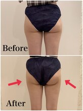 スペチアーレ 夙川/柔らかい脂肪には脂肪冷却