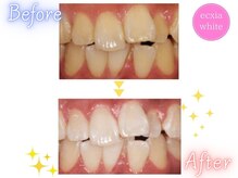 エクシアホワイト 宮崎花ヶ島店/ホワイトニングビフォーアフター