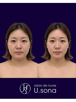 小顔・脂肪コントロール専門 salon de nurse U.sona～松本店～/【顔造形】30代脂肪分解症例