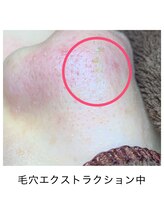 シェソワ(Chez soi)/毛穴エクストラクション中の様子