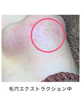 シェソワ(Chez soi)/毛穴エクストラクション中の様子