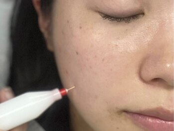 モガナ(mogana)の写真/最新機器で垢化させシミケア◎繰り返し行う事で美肌へと導きます♪一人一人にあったケアプランをご提案！