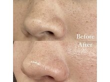 シェリ(Cheri)/部分フェイスワックス