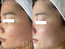 リツ(Ritsu)/ニキビケア/赤み/毛穴/美白